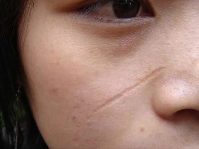 凹陷和凸起，疤痕为什么会产生不同？