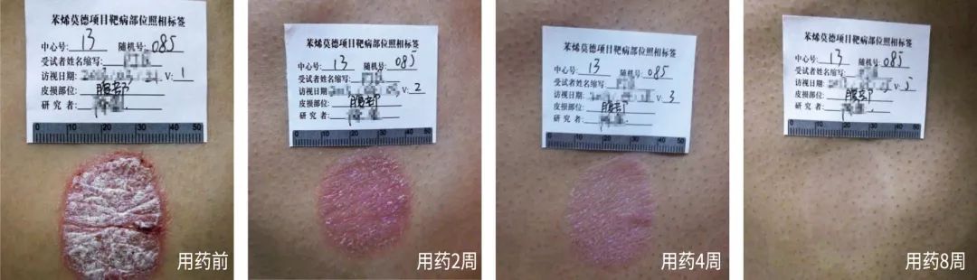 银屑病重磅新药欣比克，使用后的效果究竟怎么样？临床数据告诉你