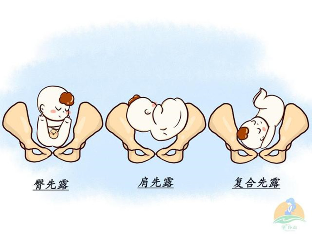 遇上胎位不正的情况，这些纠正方法，孕妈们可以了解一下