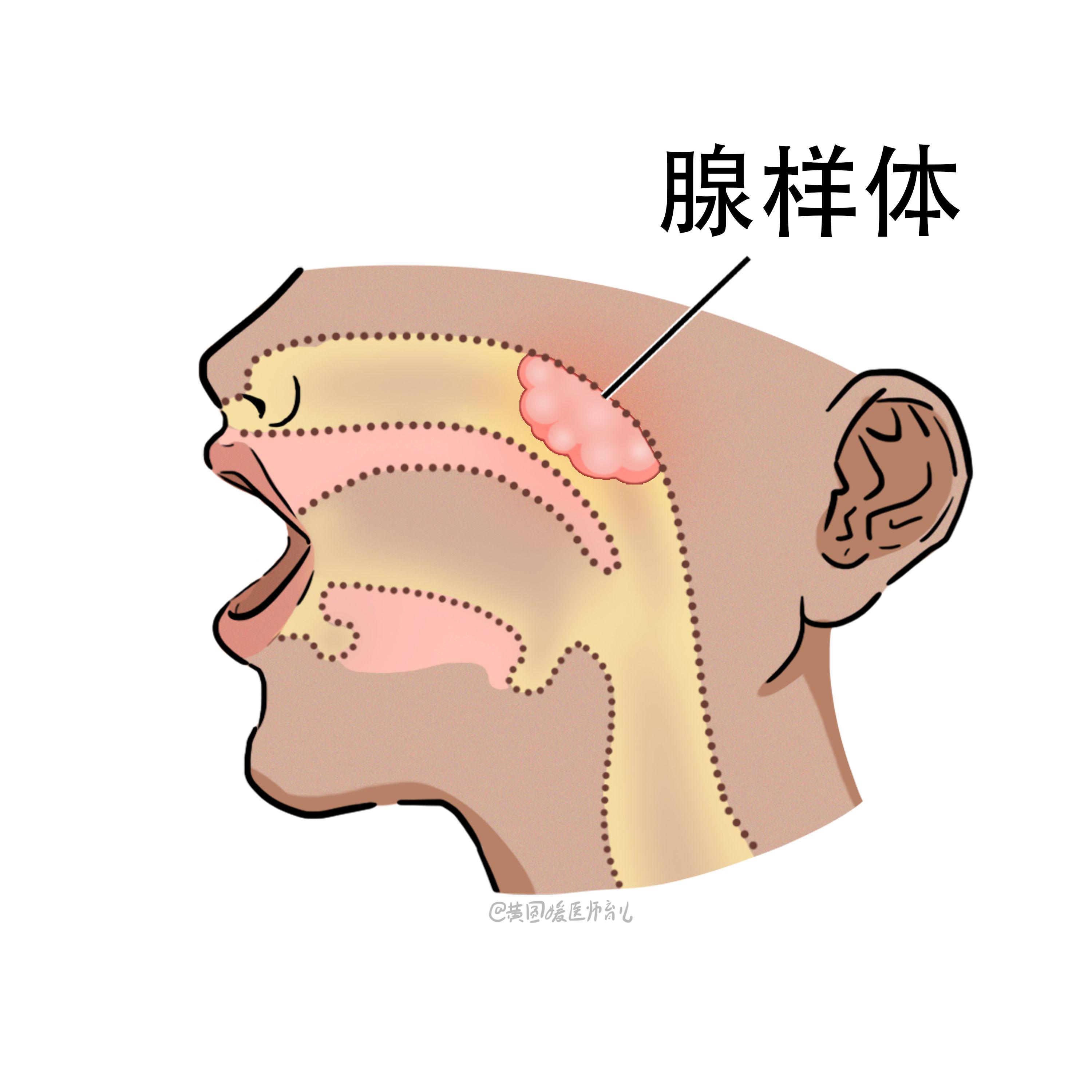 细菌性感冒的致病机制：病毒与细菌如何侵入人体引发疾病
