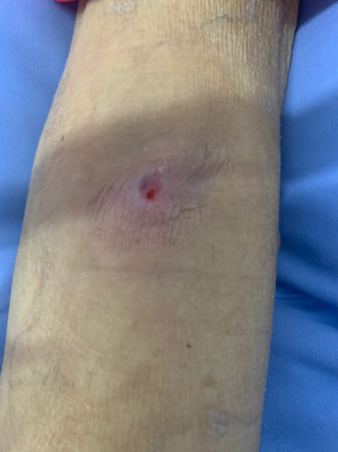 静脉输血后四级静脉炎，氧疗+水胶体贴敷轻松搞定