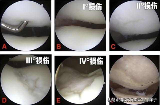 走走路突然膝盖就软了，要摔倒，还疼，是啥情况？医生详细告诉您