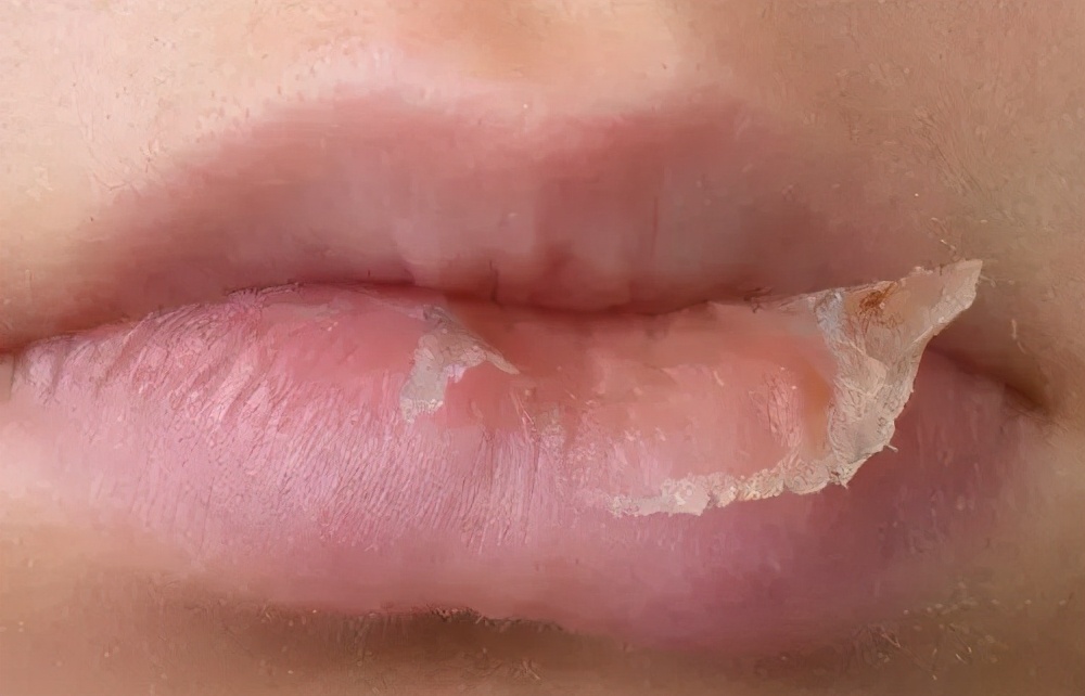 嘴唇又起皮了，干燥皲裂很难看，别舔别咬，医生告诉你该怎么办