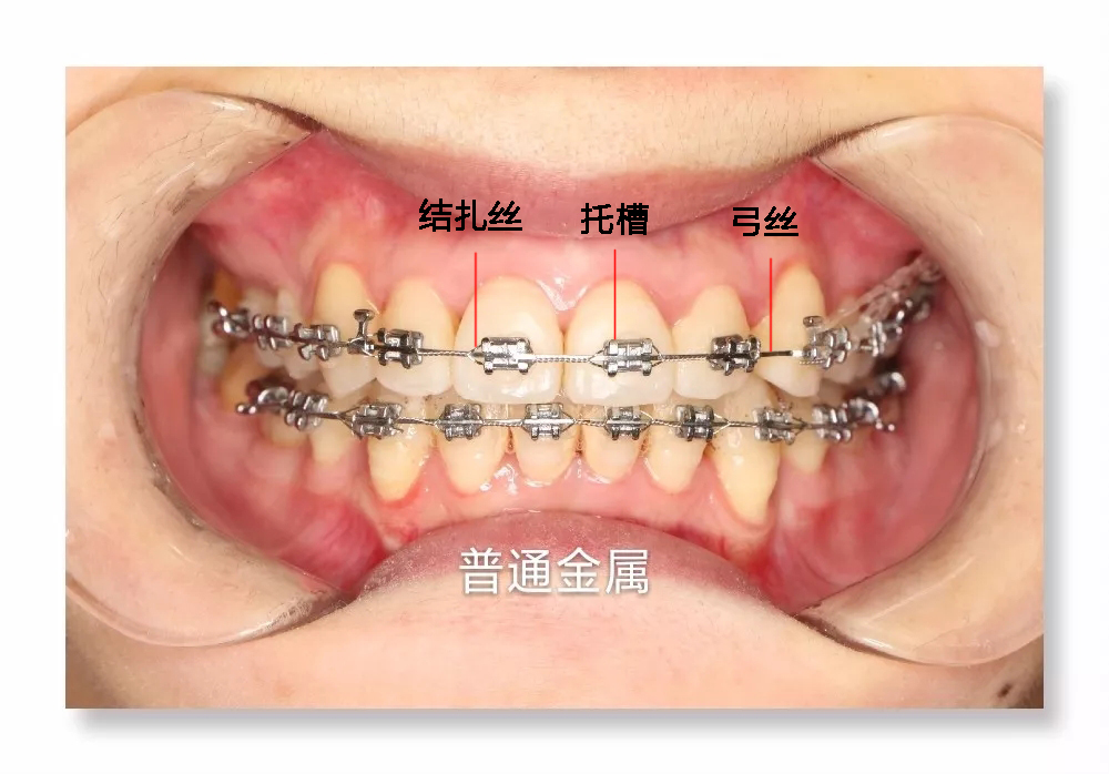 牙齿矫正最低多少钱？