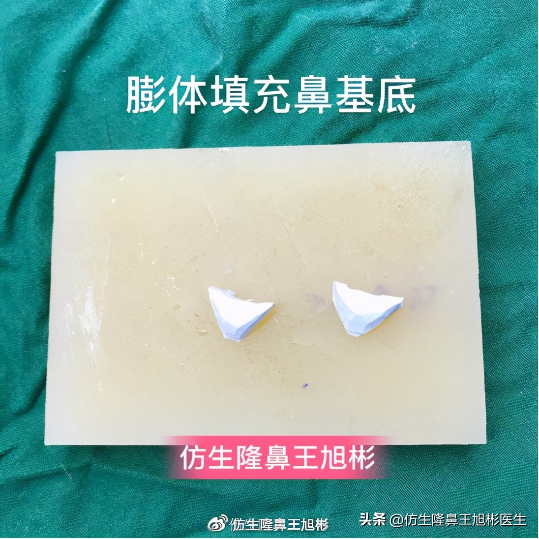 玻尿酸、脂肪、肋软骨、膨体、硅胶、人工骨…哪种鼻基底填充材好