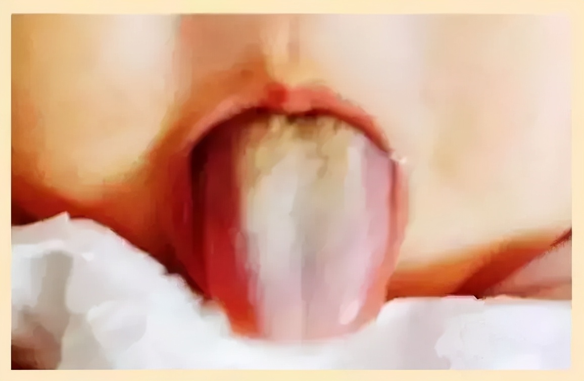 地图舌背后的惨痛经历!没有自以为是的爱,就没有伤害