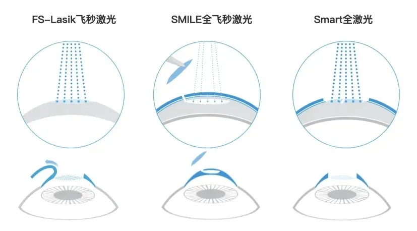 做一次激光近视手术,到底要多少钱?