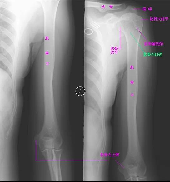 学习 X线读片指南 骨 关节系统 肱骨 天天看点