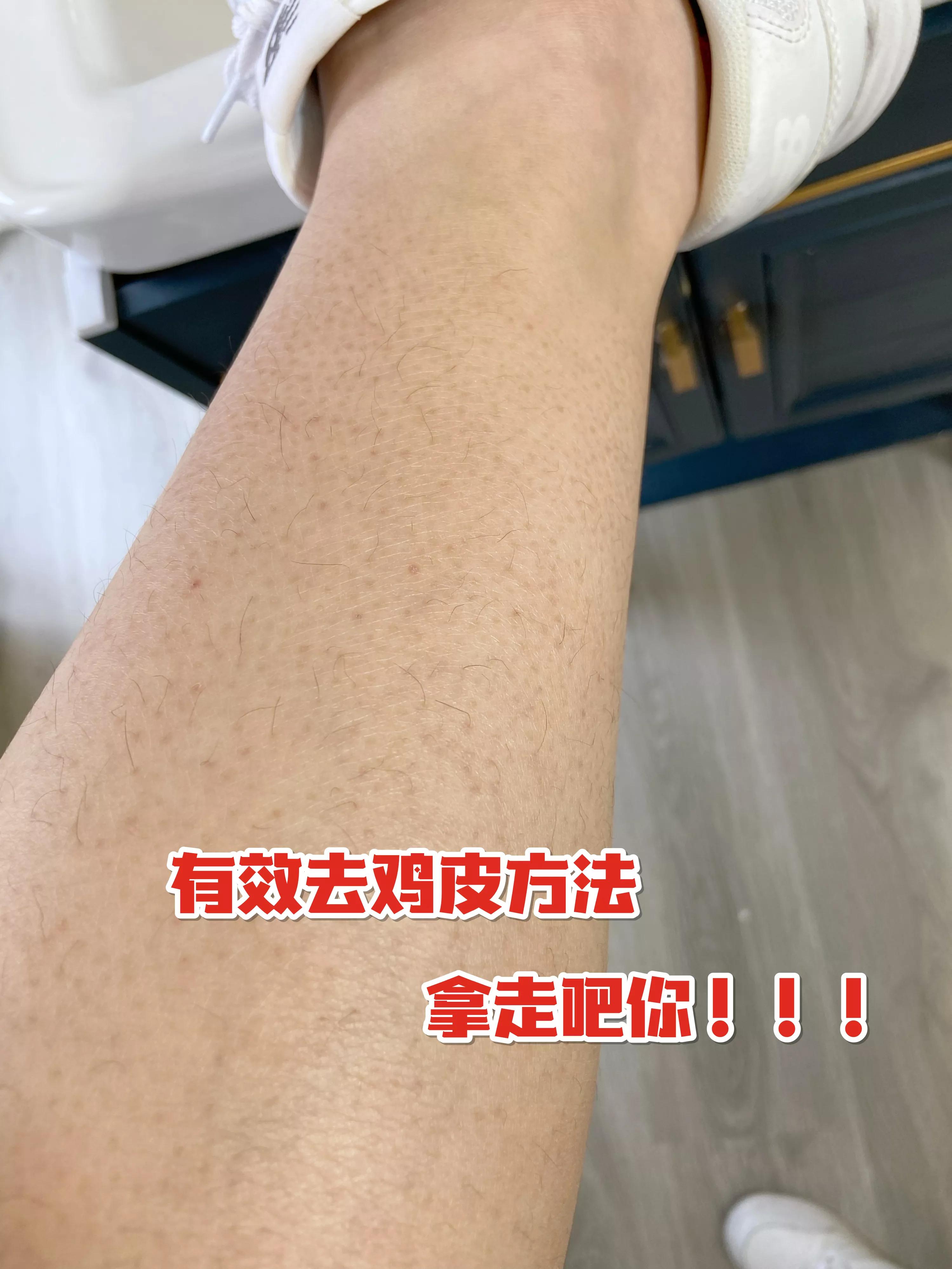 条码纹身腿部鸡皮皮肤怎么办(腿上纹纹身的时候有腿毛怎么办)