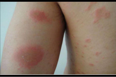 婴儿梅毒疹子图片(上覆糠秕样鳞屑的玫瑰色的斑丘疹) - 乐宝宝贝