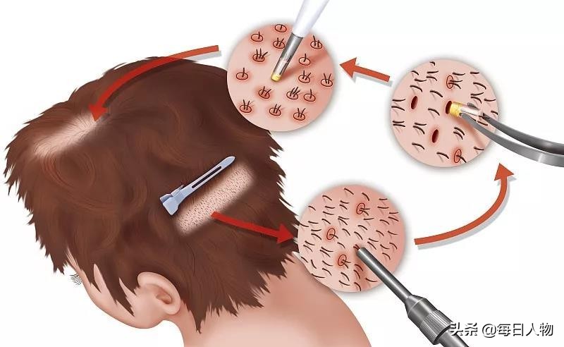 中国脱发人群数量达2亿，植发真的能拯救中国人的发际线吗？