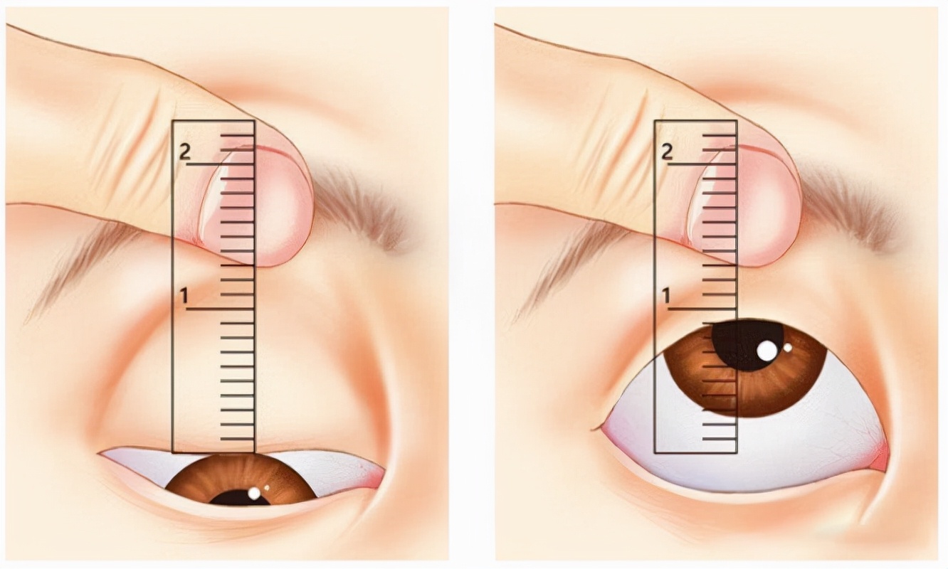 就是为了检查眼睛是否存在眼睑下垂的必查项目之一,这关乎到双眼皮术