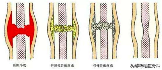 伤筋动骨，必须要一百天才能好？骨科医生：不一定