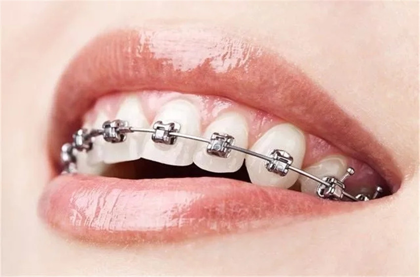 为什么大部分泰国人都带上了牙套？身为微笑民族，怎能牙齿不齐呢