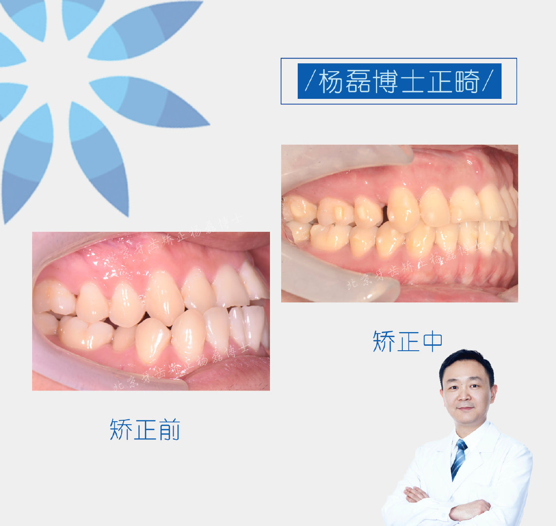 ​​杨磊博士 「骨性反颌偏颌正畸正颌联合治疗病例」