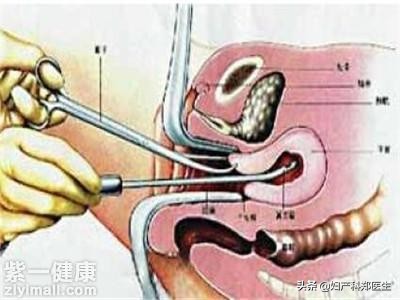 清宫手术分为二个步骤进行