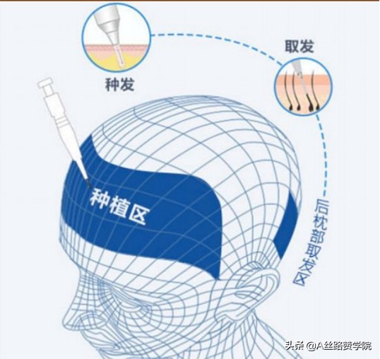 “头等大事”！浅谈医药行业-植发子赛道市场