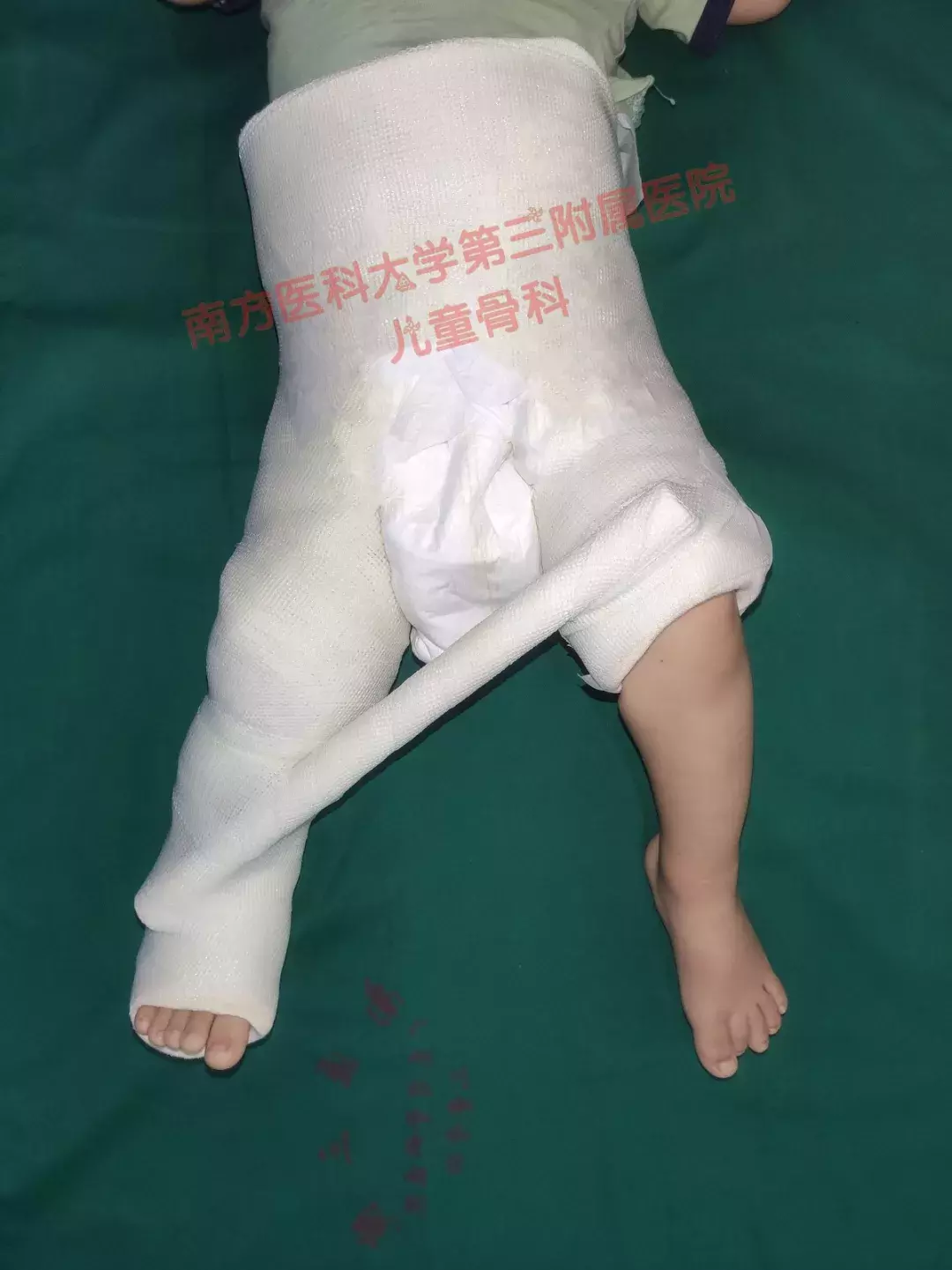 婴儿髋关节不对称图片(宝宝臀纹不对称妈妈不上心) - 赤虎壹号