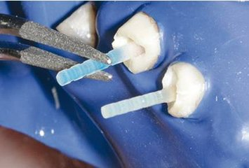 为什么有些牙齿缺损后需要打桩才能修复？不同的桩冠区别在哪？
