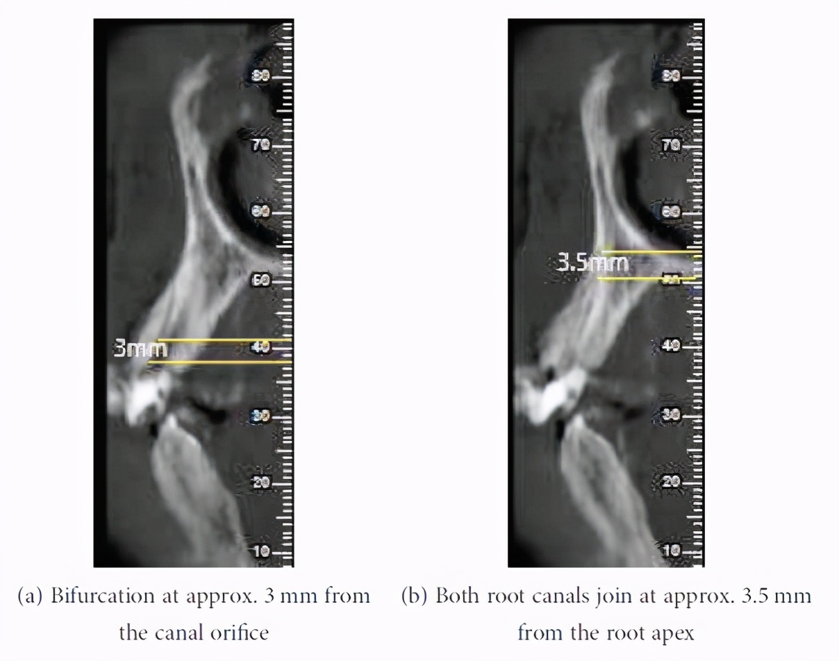 罕见病例！上颌犬牙Vertucci Ⅲ型结构的牙髓治疗