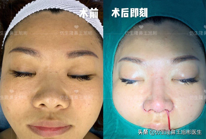 单纯隆鼻是什么，和综合隆鼻有什么区别？