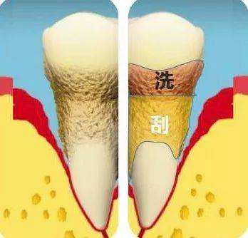 什么是龈下刮治？治疗过程疼吗？会打麻药吗？专业牙医告诉你