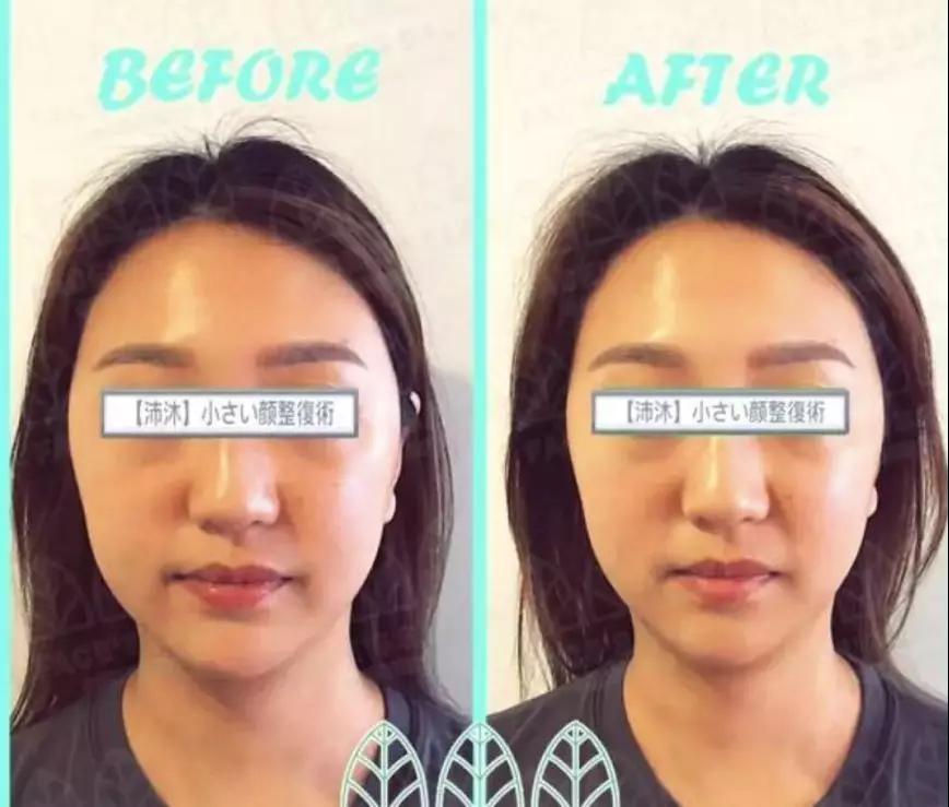 纯手法、不打针、不动刀，日式小颜整骨“徒手变小脸”靠谱吗？