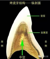 烤瓷牙、全瓷牙哪个更好？优缺点对比分析