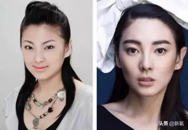姐妹,双眼皮再好,咱也别硬割啊