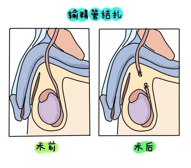 就像太監,事實上結紮和太監的閹割完全不同,太監會把兩個蛋蛋都切除了