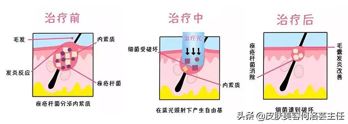 治痘神器——红蓝光，效果怎么样？到底有没有用？