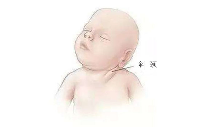 宝宝侧睡造成窄头长脸图片