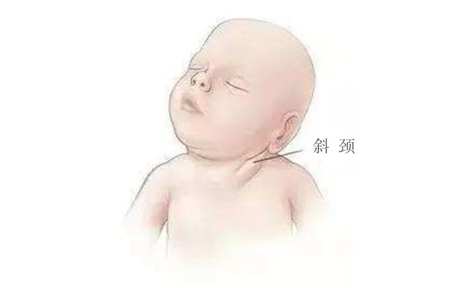 孕妈朝一个方向睡会导致宝宝"歪脖子"?不了解这两点就别乱说