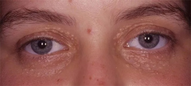 毛周角化?影响美观的小颗粒,怎样快速有效去除?