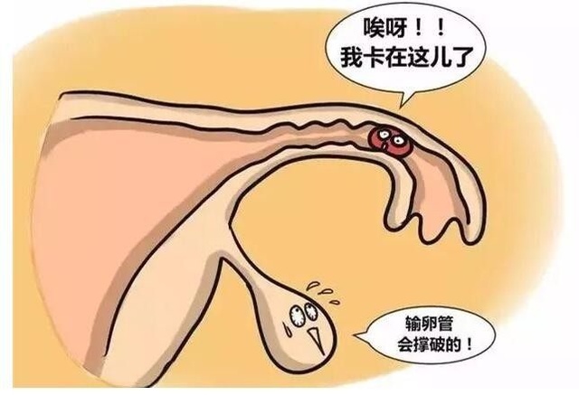 如何及时制止宫外孕！你想知道的在这里
