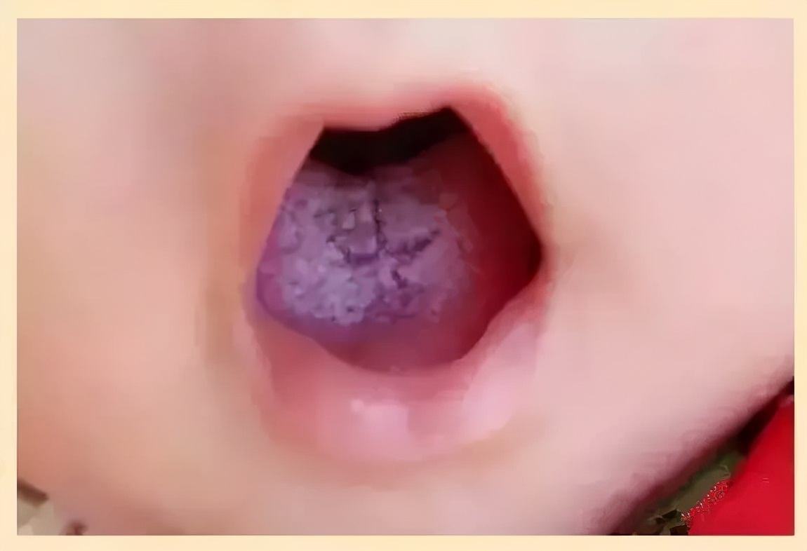 地图舌背后的惨痛经历!没有自以为是的爱,就没有伤害