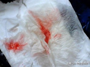 早上痰中带血是怎么回事(咳血)