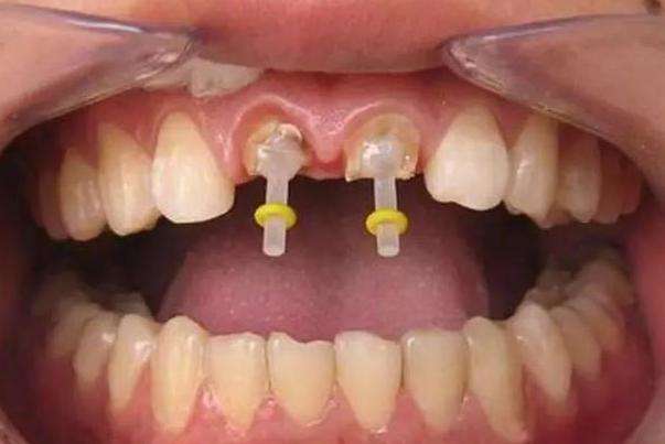 牙齿打桩是什么意思？不同的材质有什么区别？牙科医生教你怎么选