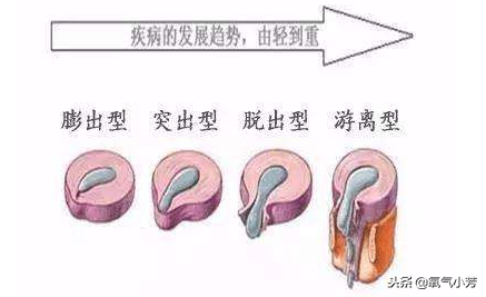 腰突症，不要再花冤枉钱了，你的自愈力与自律程度，才是恢复根本