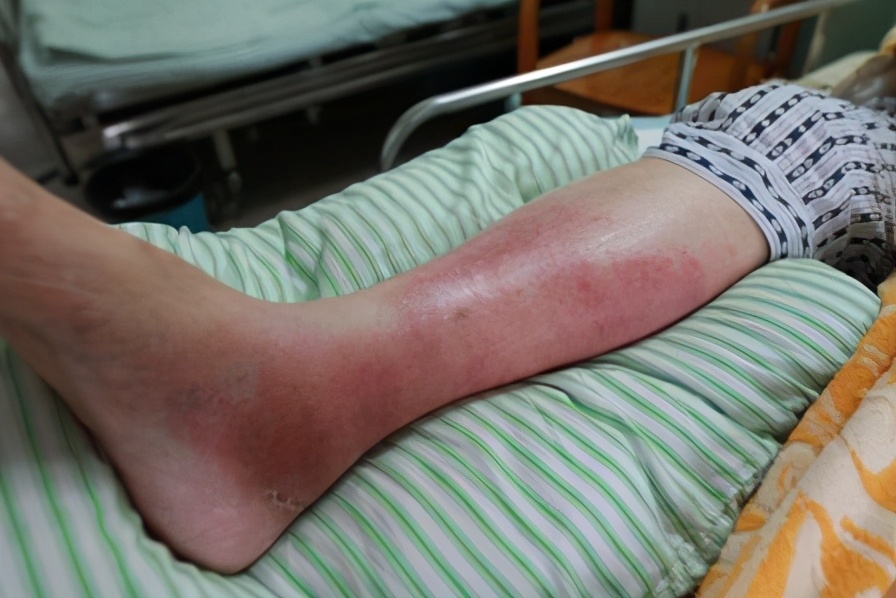 痛风自鉴手册来了!别认错了病,挂错了号,买错了药,白疼半天