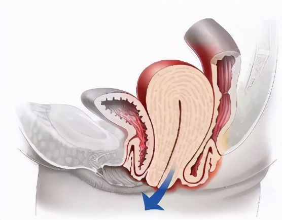直肠脱垂，可以自行恢复吗，还是想要一托了之，恐怕没那么简单