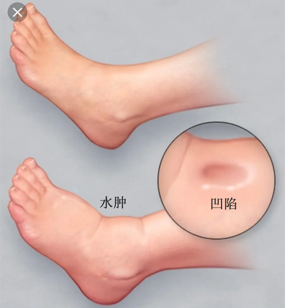 不同部位的「肿」暗示了什么？一组“水肿位置图”搞清楚