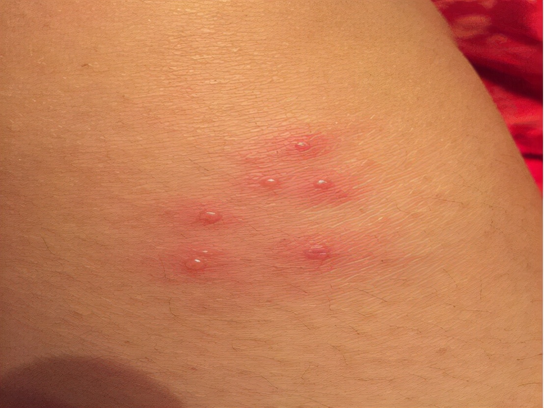 被隐翅虫咬伤急救指南,毒液酸性或可堪比硫酸?