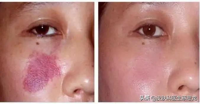 一文读懂|光子嫩肤全解析