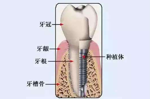 为什么有些人做种植牙，得先植骨？植入的到底是什么？