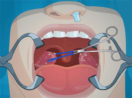 扁桃体经常发炎别大意，出现这四种症状之一，就得赶紧去医院