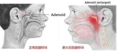 还在以为宝宝打呼噜是遗传吗？出现以下这几点要注意了