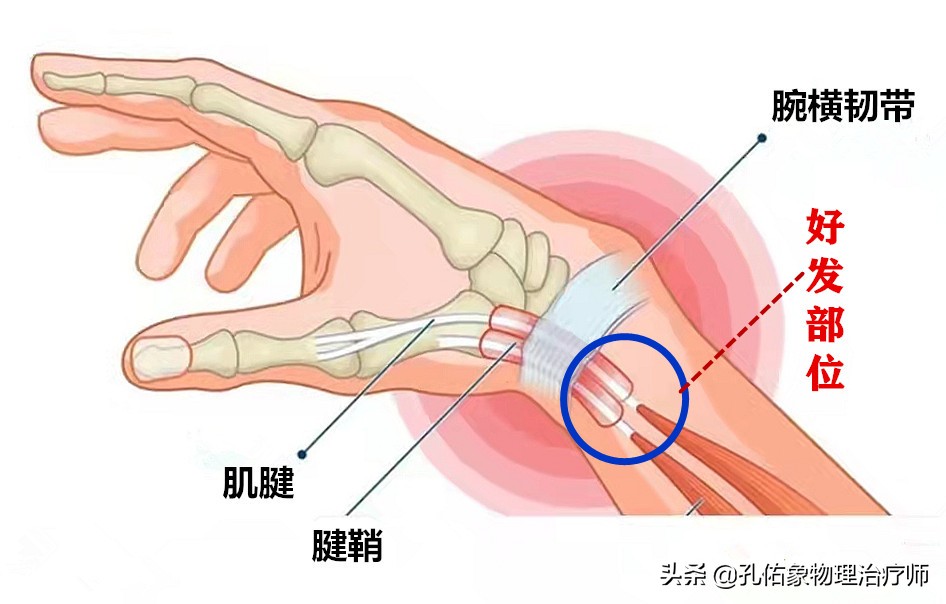 中老年女性常手指疼痛、肿胀，是腱鞘炎吗？该怎么办？告知您