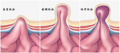 股沟的位置图片图片
