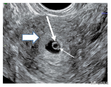 怀孕后早孕期B超图怎么看？医生详解，图文并茂